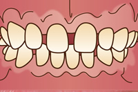 全体的なすきっ歯