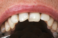 前歯の重なり